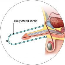Устройство стимуляции эрекции - аппарат "Мустанг-ДинаВак-Андро"