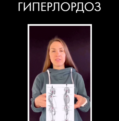 Гиперлордоз (Христина Жарикова)